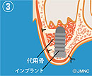 サイナスリフト