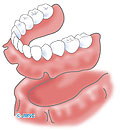 総入れ歯とインプラント