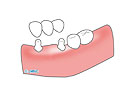 ブリッジ治療のイメージ