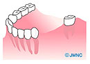 下顎臼歯欠損