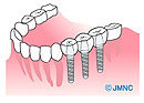 下顎インプラント