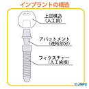 インプラントとは