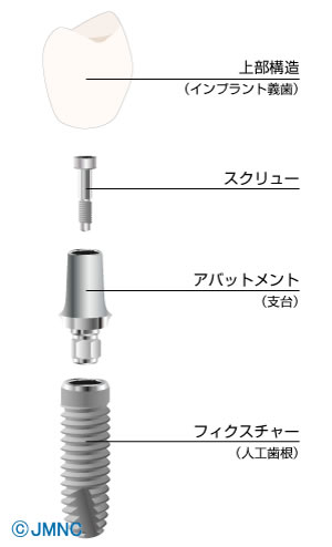 インプラント治療の歯科医院向け 無料イラスト素材集 インプラントネット