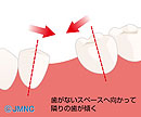 歯を失った方へ