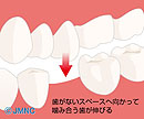 歯を失った方へ