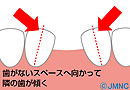 歯を失った方へ