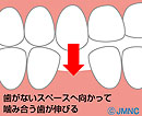 歯を失った方へ