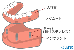 マグネットデンチャー(磁性アタッチメント)での治療