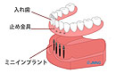 ミニインプラントと義歯