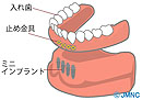 ミニインプラントと義歯