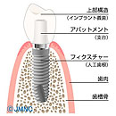 インプラントとは