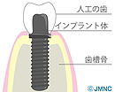 インプラントとは