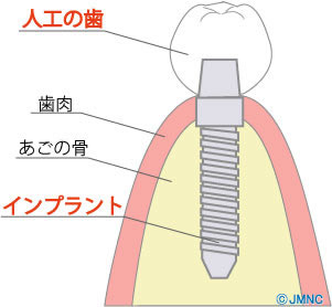 インプラント ネット イラスト素材集