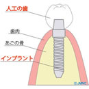 インプラントとは