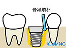 抜歯即時インプラント