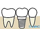 抜歯即時インプラント