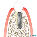 抜歯即時インプラント