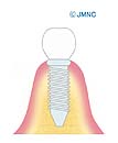 インプラント周囲炎