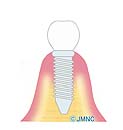 インプラント周囲炎