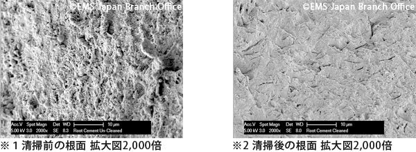清掃前後の根面の拡大図