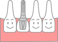 歯を失ってお悩みの方に…インプラント治療とは?