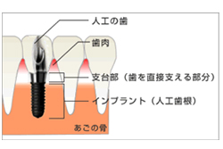 インプラント治療とは