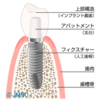 インプラント治療について