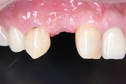 1DAYインプラント