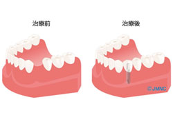 CASE01 歯を1本失った場合