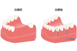 CASE02 歯を何本か失った場合