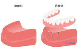 CASE03 全ての歯を失ってしまった場合