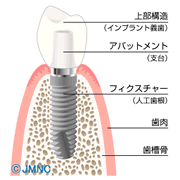 インプラントのメリット
