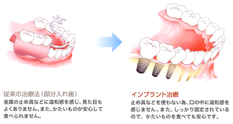 奥歯を失った場合