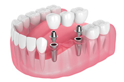 歯周病管理を重視し長く使えるインプラント治療