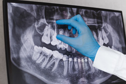 様々なインプラント症例に対応