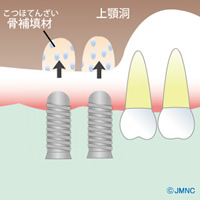 ソケットリフト