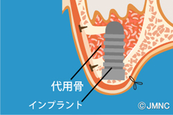 サイナスリフト