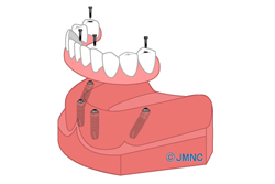 All-on-4(ޤAll-on-6)