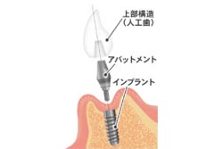 インプラント治療とは