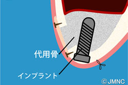 サイナスリフトとは