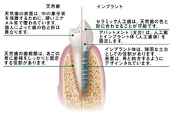 当院のインプラント治療