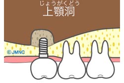 ソケットリフト