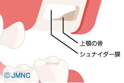 サイナスリフト