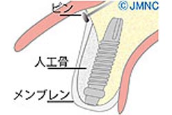 GBR法(骨誘導再生法)