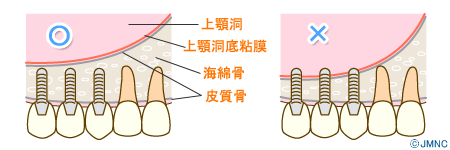 インプラント補助手術「骨再生治療」について