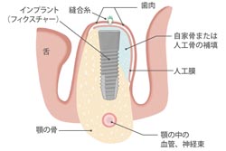 骨誘導再生法(GBR)