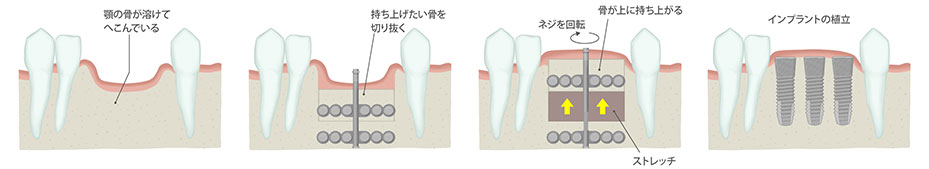 仮骨延長術