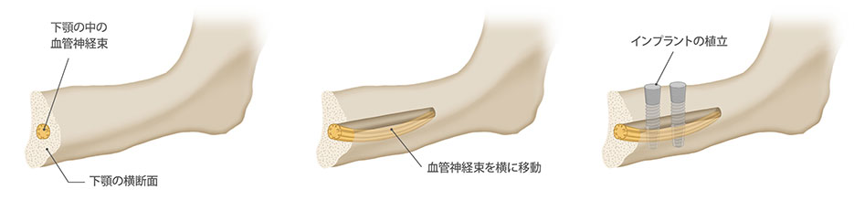 下歯槽管側方移動術
