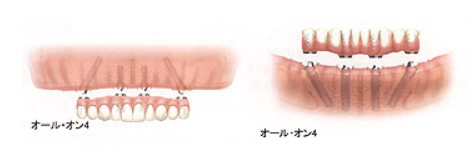All-on-4(オールオンフォー)