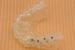 手術用ガイドを活用したインプラント手術